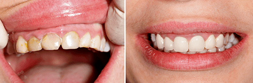 zirconia restorations crown - First Choice Dental Lab®