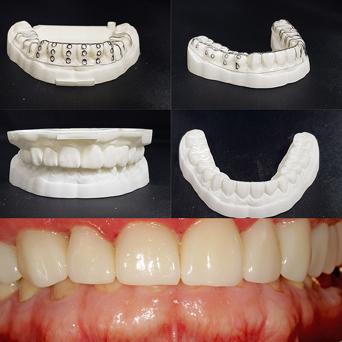 Digital Workflow for a Dental Restoration - Chicago - First Choice Dental Lab