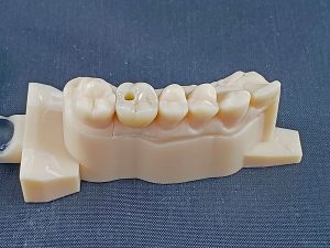 screw-retained zirconia restoration