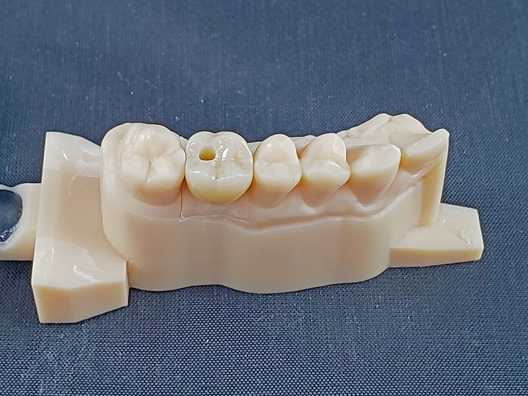 Screw-Retained or Cement-Retained Zirconia Crowns?