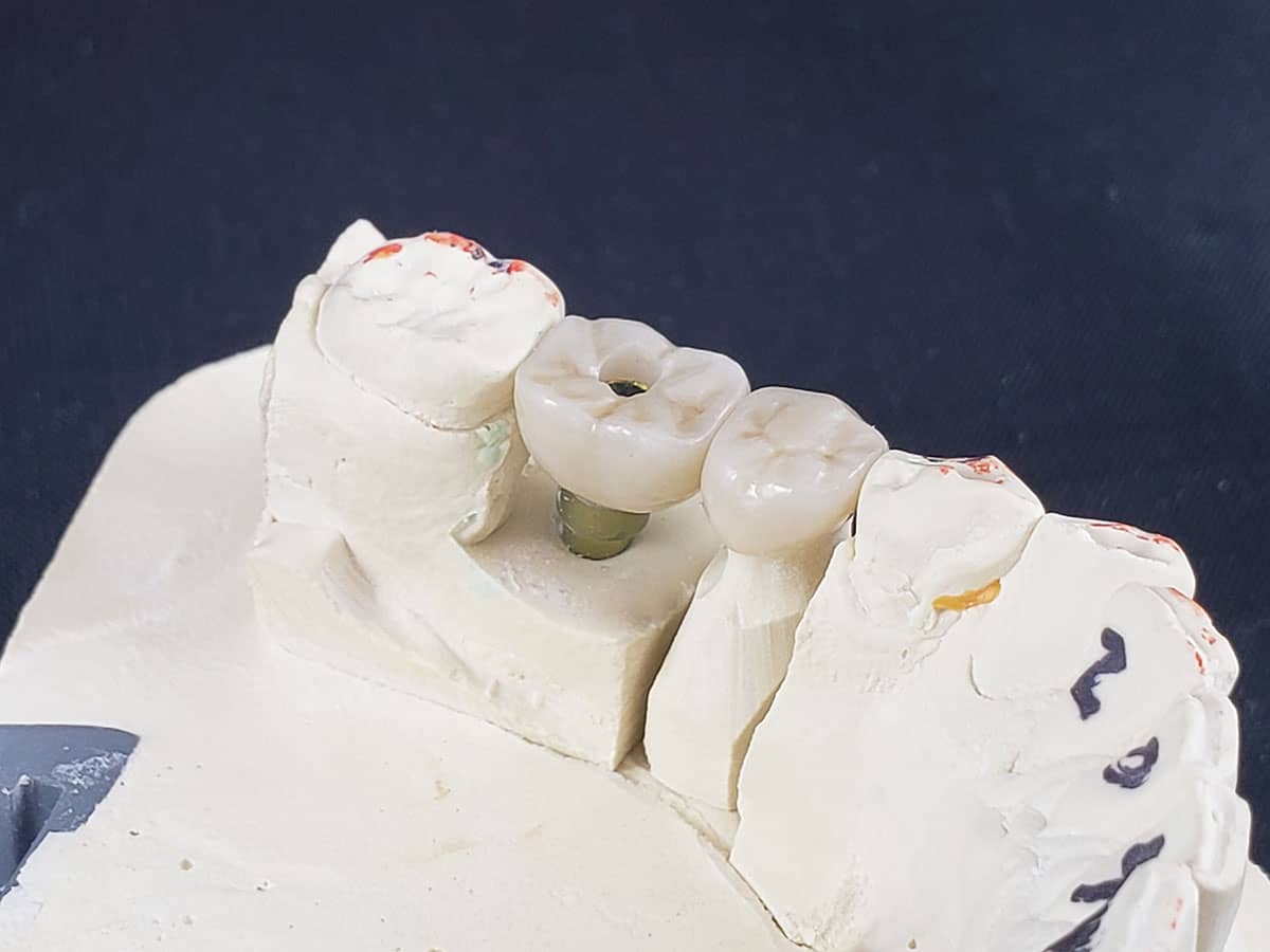 screw-retained implants - dental implants - First Choice Dental Lab