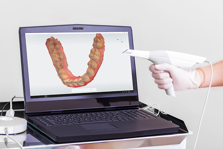 Digital impressions - dental impression scanner