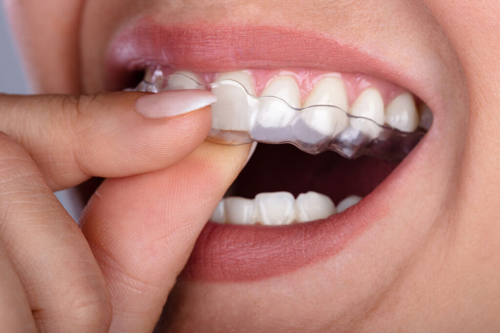 clear aligners in dentistry