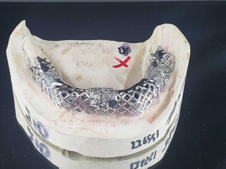 Case of the Day: First Choice Dental Lab - Haden clip-retained denture