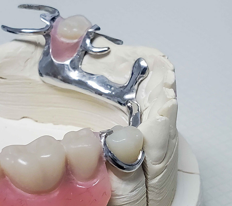 Crown Under Partial - First Choice Dental Lab