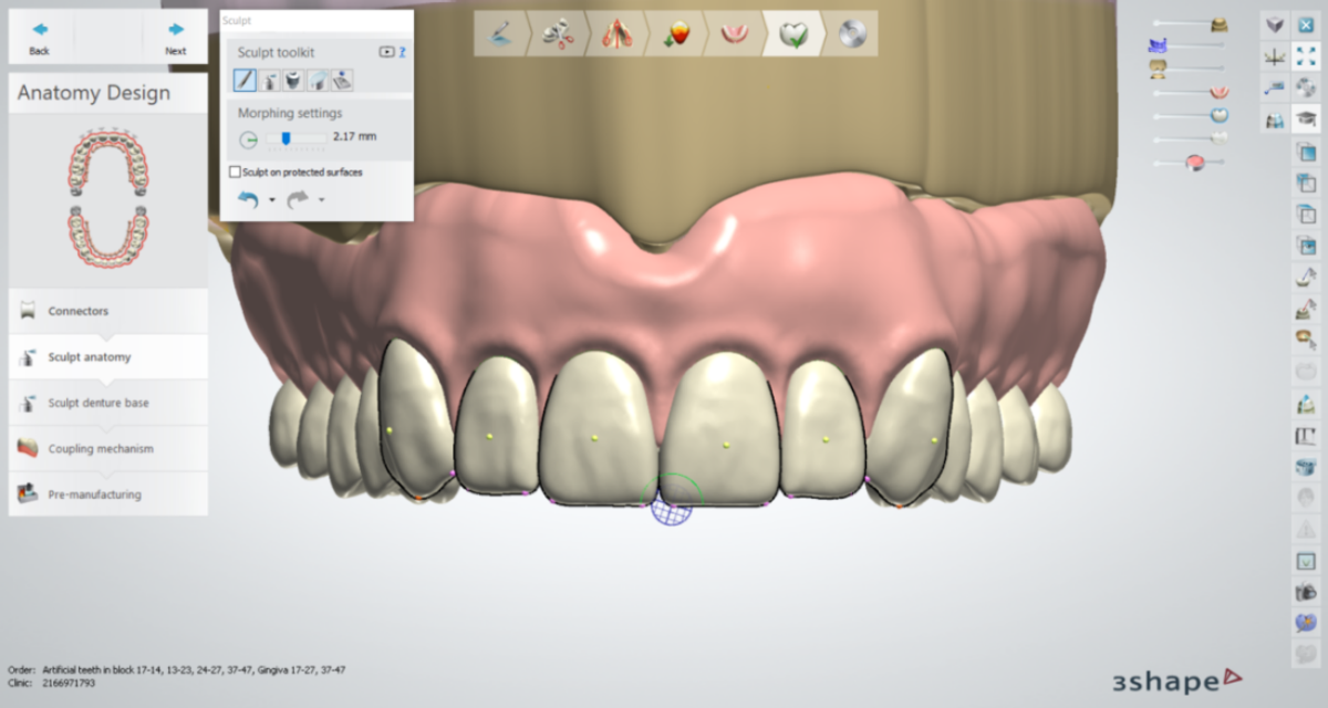 A screenshot of the digital denture workflow process using 3shape software