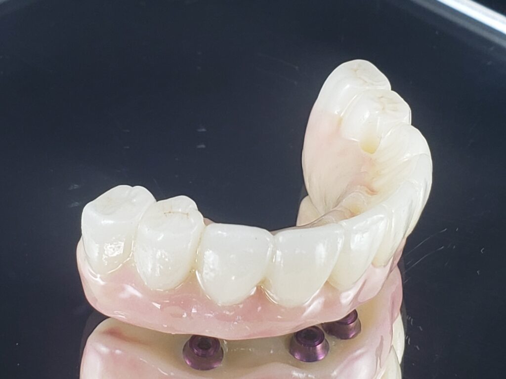 A photo of a full-arch case created by First Choice Dental Lab. It is made of zirconia, used for crown and bridge dental work.