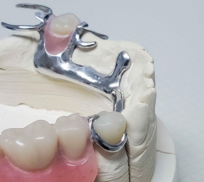 Crown Under Partial - First Choice Dental Lab